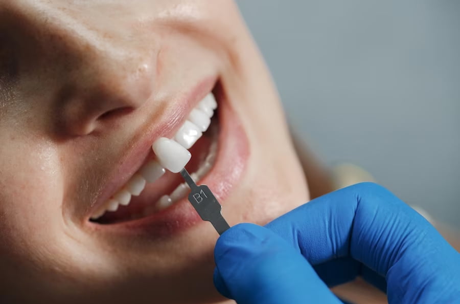 Coroane dentare Bucuresti