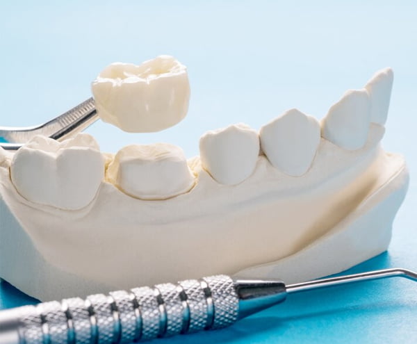 Coroane dentare Bucuresti