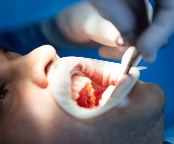 Coroane dentare Bucuresti