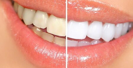 Cum sa ai un zambet de milioane: 6 motive pentru care merita sa apelezi la igienizarea profesionala a dintilor