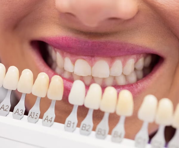 Fatete dentare Bucuresti