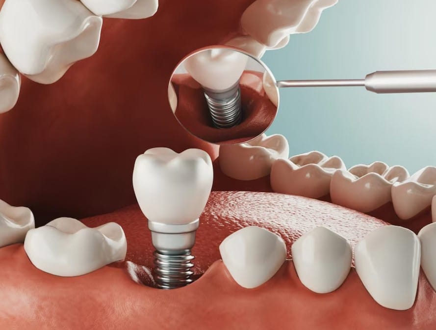 Etapele implantului dentar